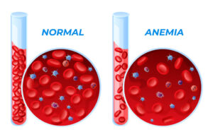 Iron deficiency anemia and normal set vector illustration. Collection difference of amount of red blood cell medical diagram test tube and microscopic structure isolated. Medicine genetic illness